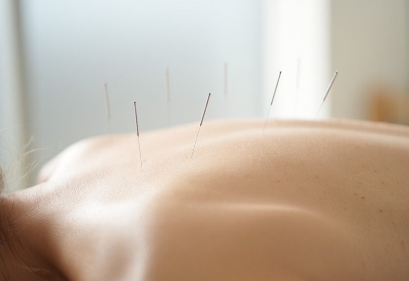 Женщина кодируется иглоукалыванием